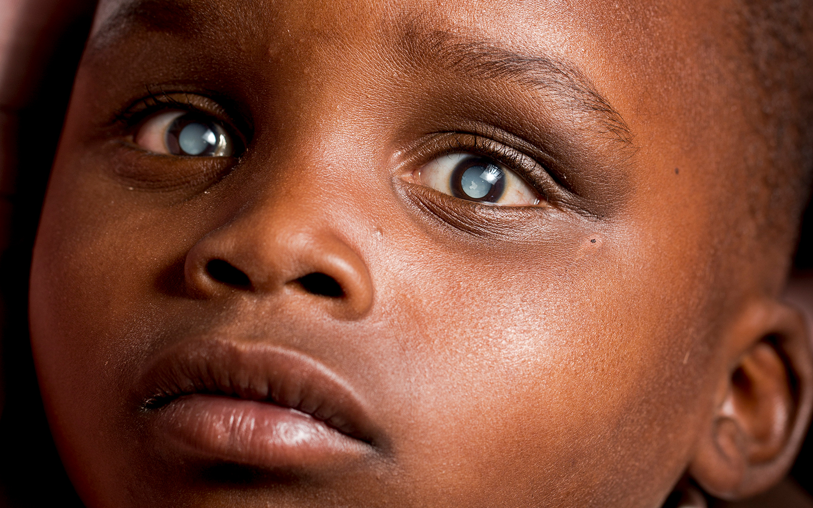 Kenya close up of Faith's cataracts