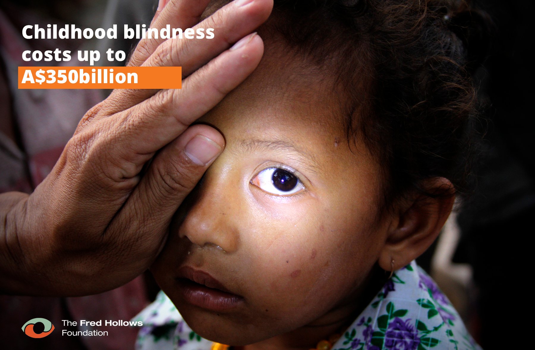 Childhood blindness costs up to $350 billion