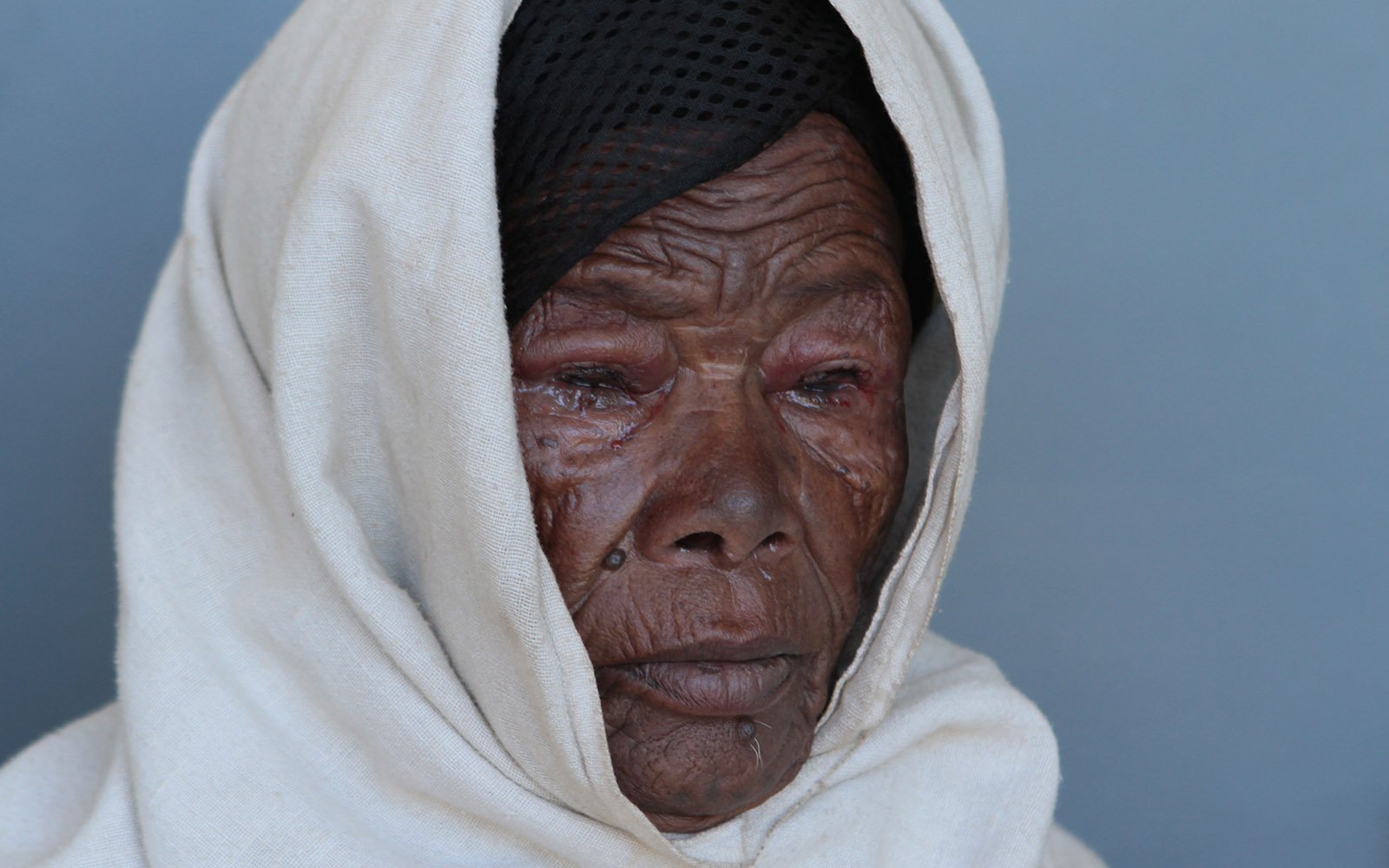 trachoma patient from ethiopia