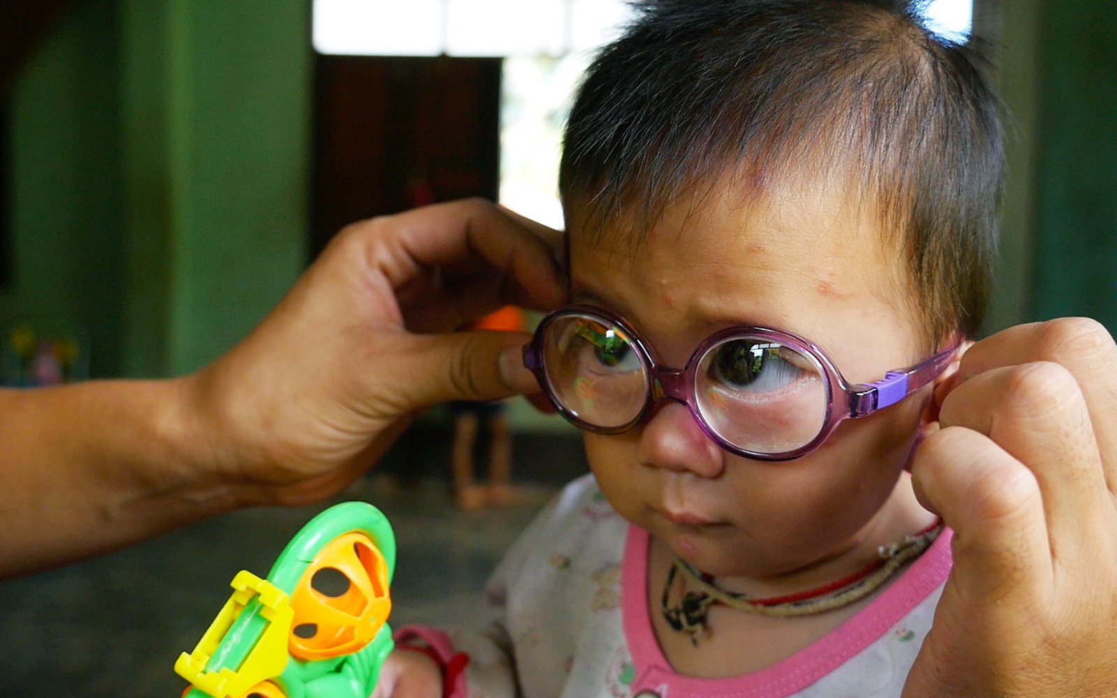 Cambodian child after cataract surgery