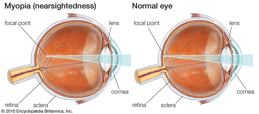 az életkorral összefüggő myopia