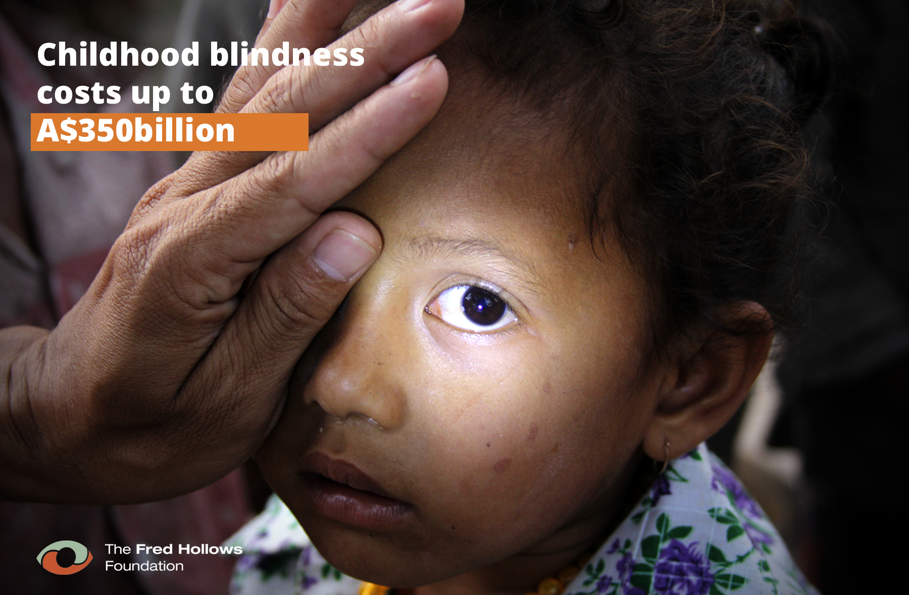 Childhood blindness costs up to $350 billion