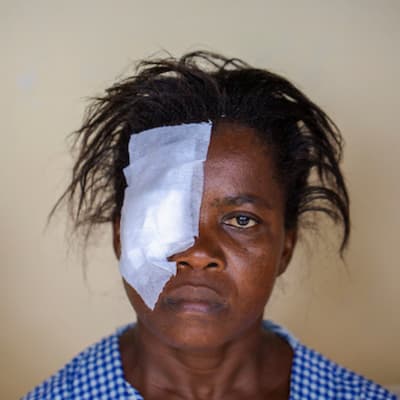 55% OF THOSE IMPACTED BY AVOIDABLE BLINDNESS ARE WOMEN