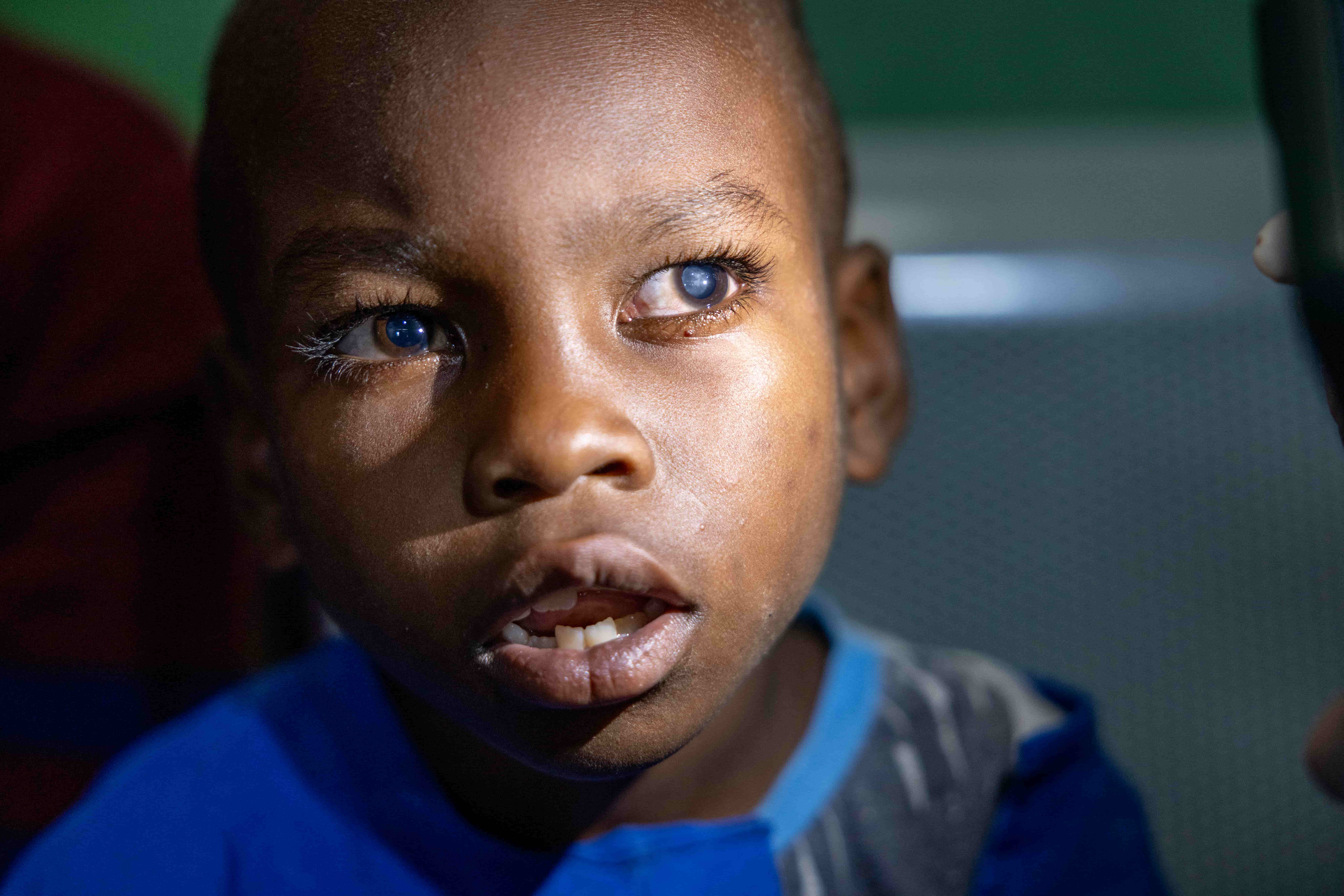 Close-up of Blaise&rsquo;s eye affected by cataract, showing a cloudy, opaque pupil that blurs the normally clear centre of the eye.