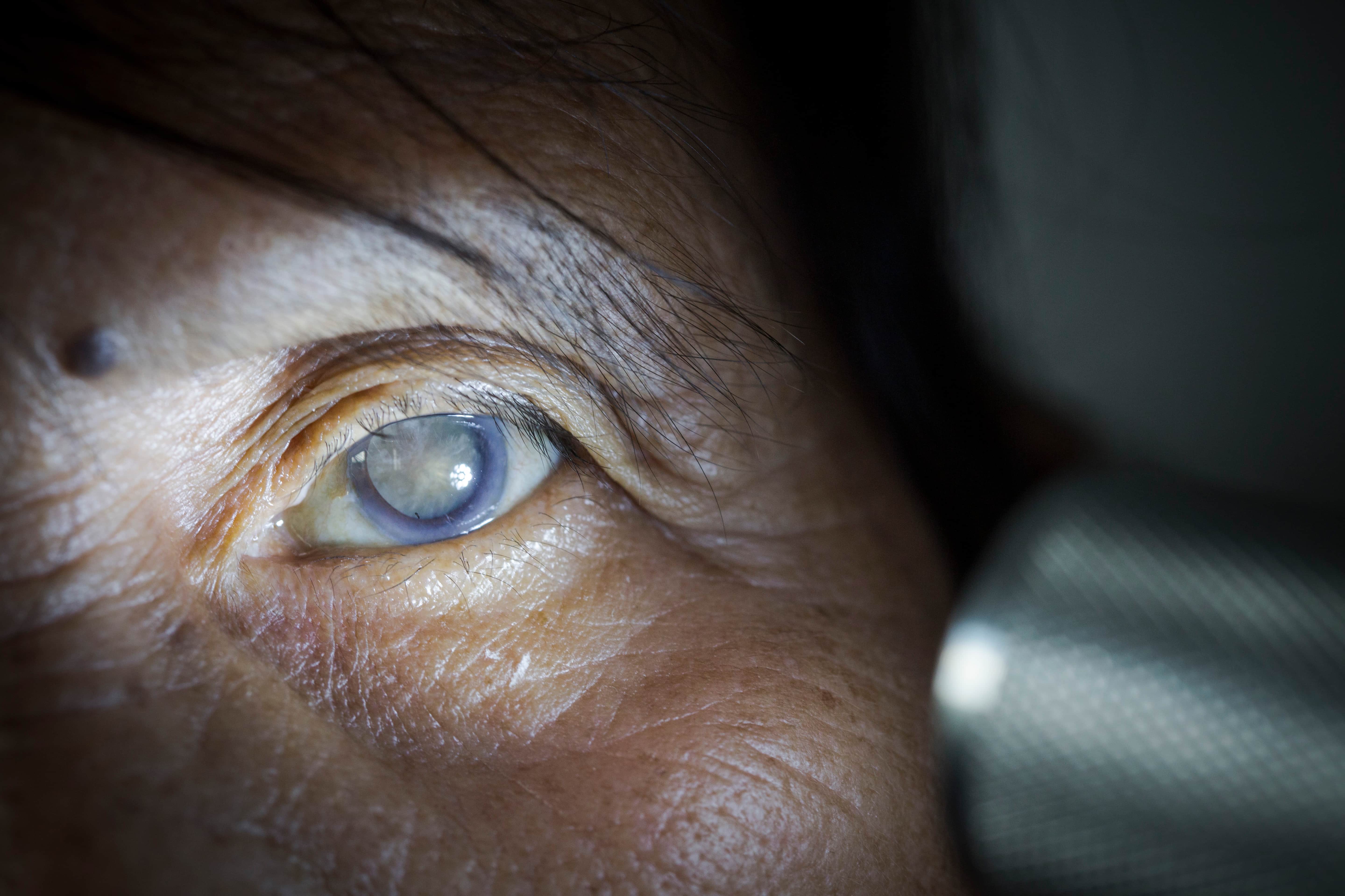 Cataract up close