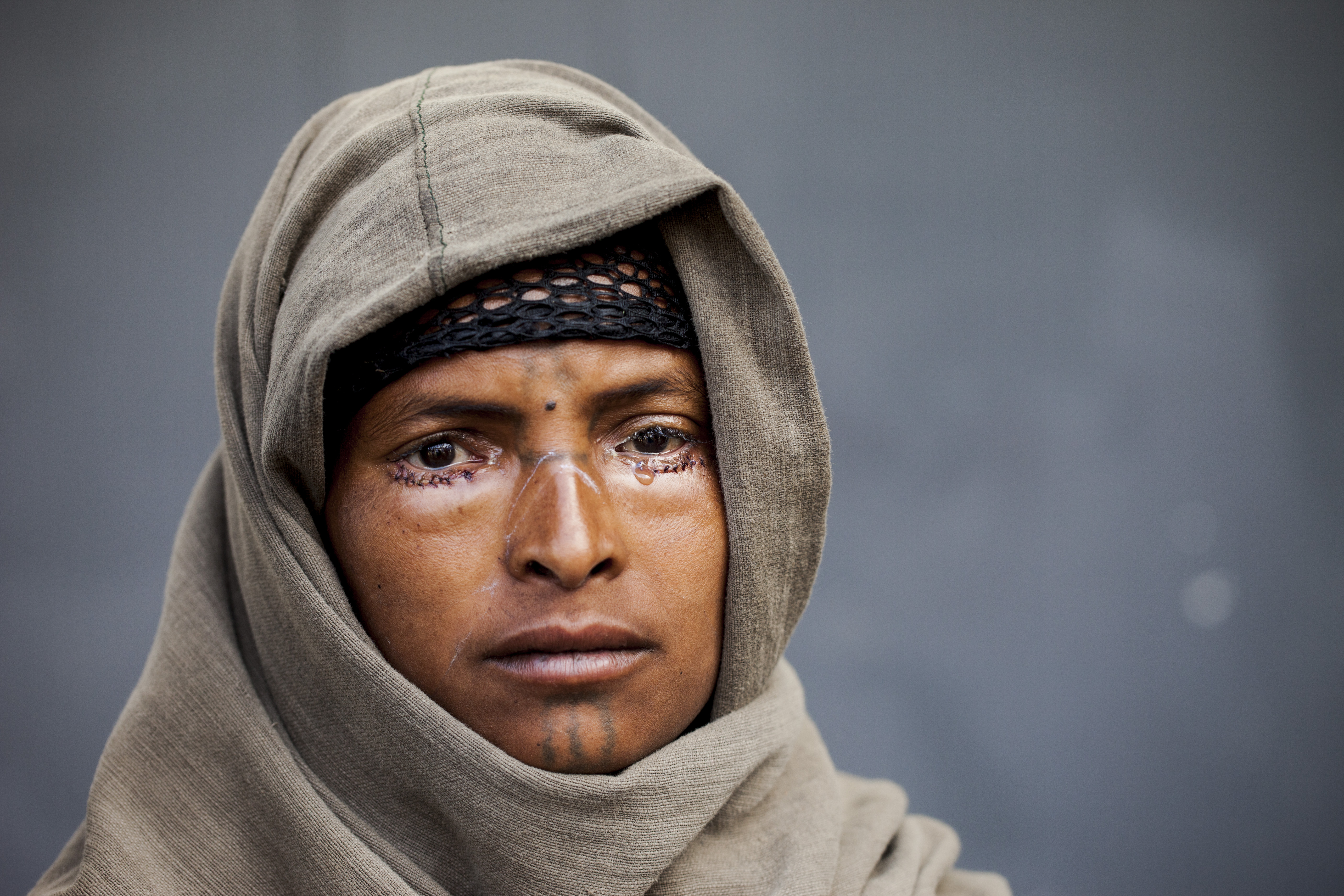 Trachoma surgery patient Azmera.