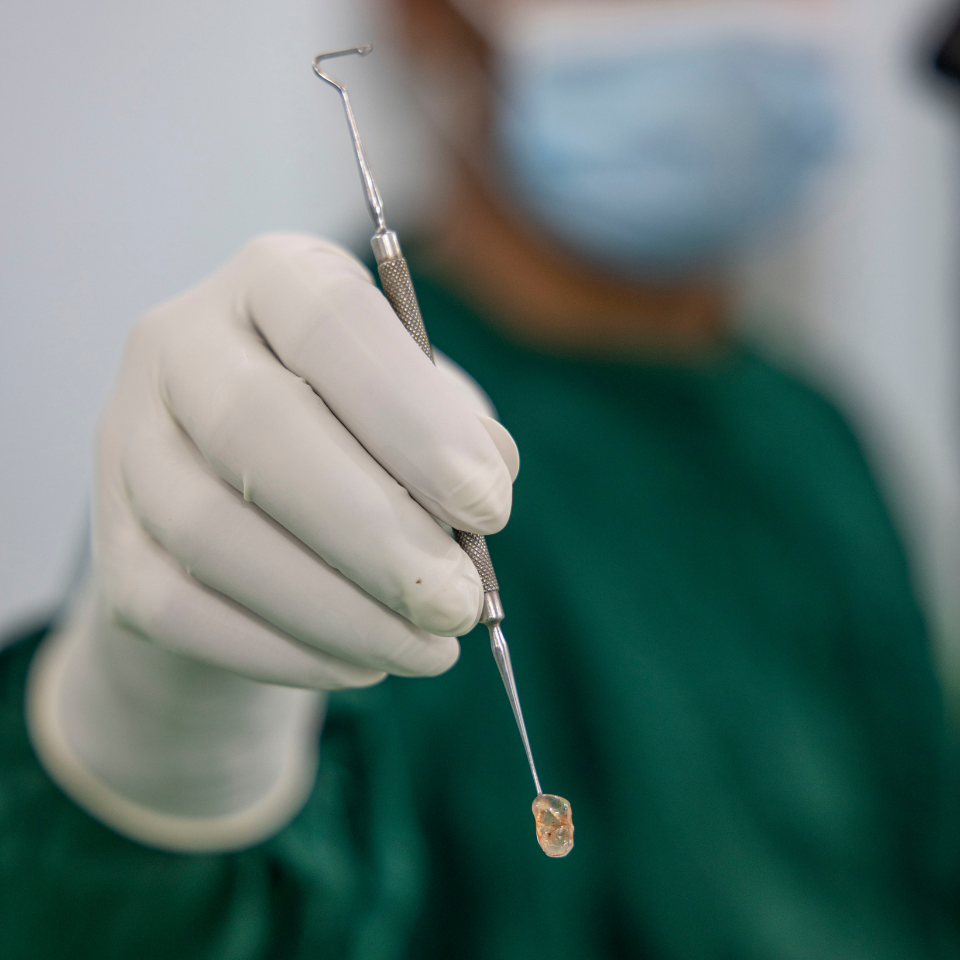 A cloudy lens moments after being removed from a cataract patient in Bangladesh
