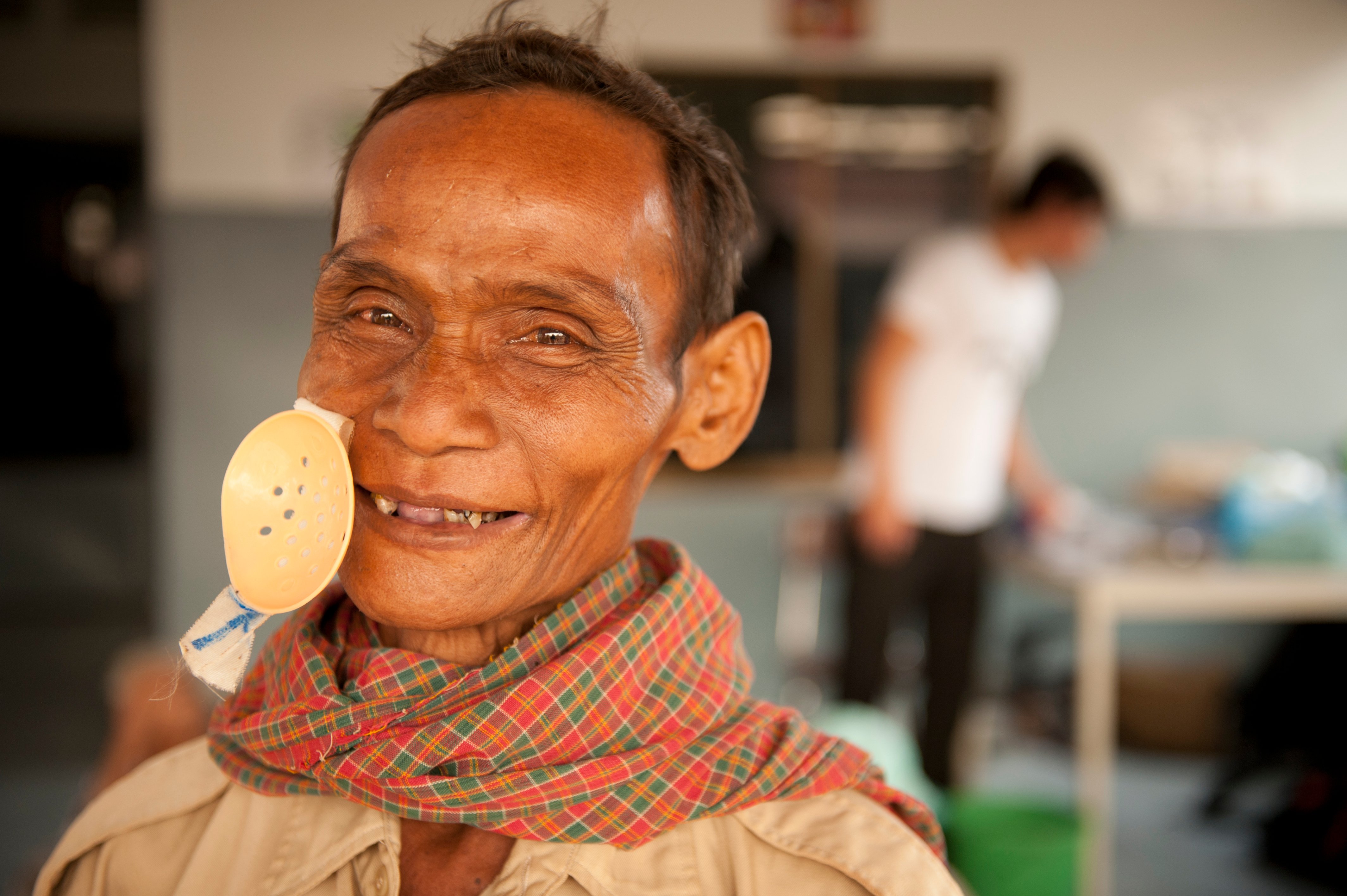 Hen Vin after bilateral cataract surgery. His patch has just been removed and he is smiling at the camera